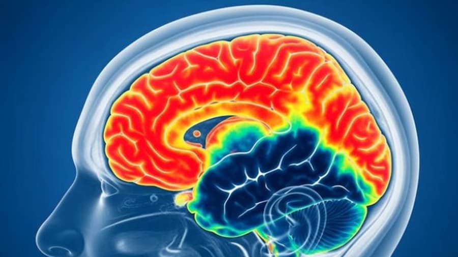 Descubren Carioptosis: Nuevo Mecanismo de Muerte Neuronal en Alzheimer y Demencia Frontotemporal