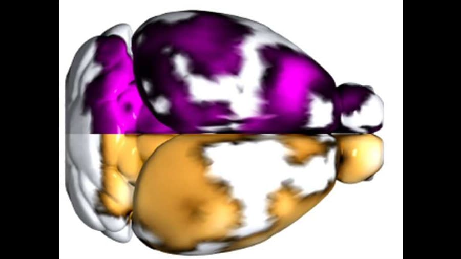 Nueva técnica no invasiva detecta microtrombos cerebrales asociados al Alzheimer