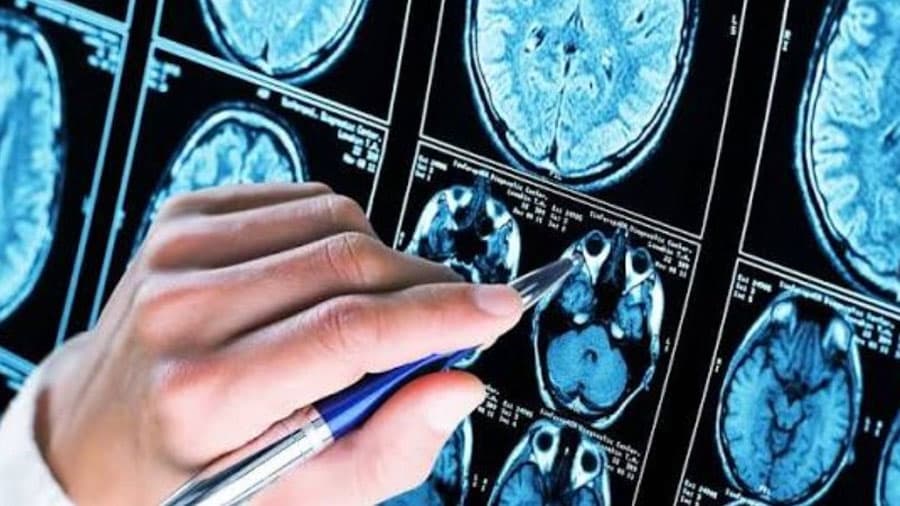Células Inmunes del Cerebro Ofrecen Nueva Esperanza Contra el Alzheimer