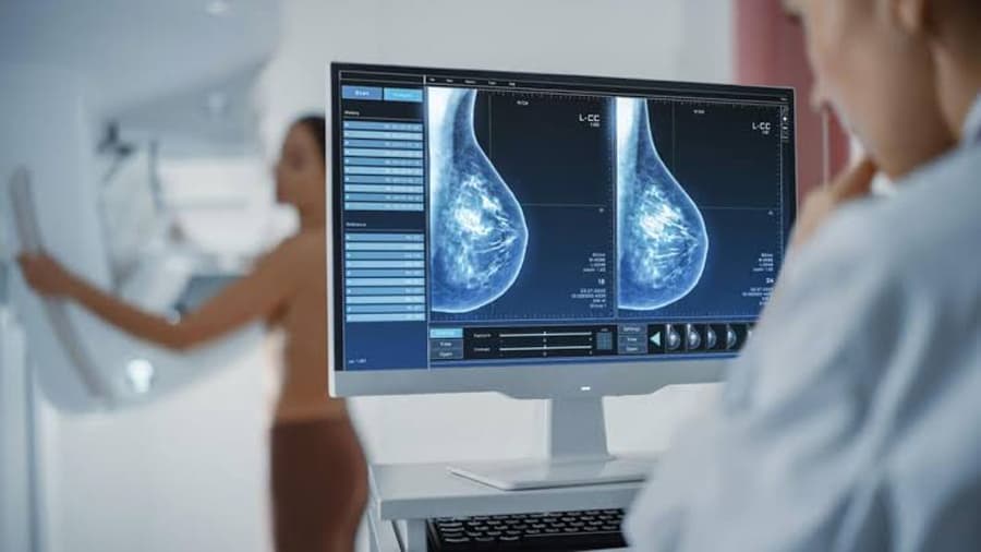 Avance clave en la lucha contra la metástasis de cáncer de mama mediante la proteína RAC1